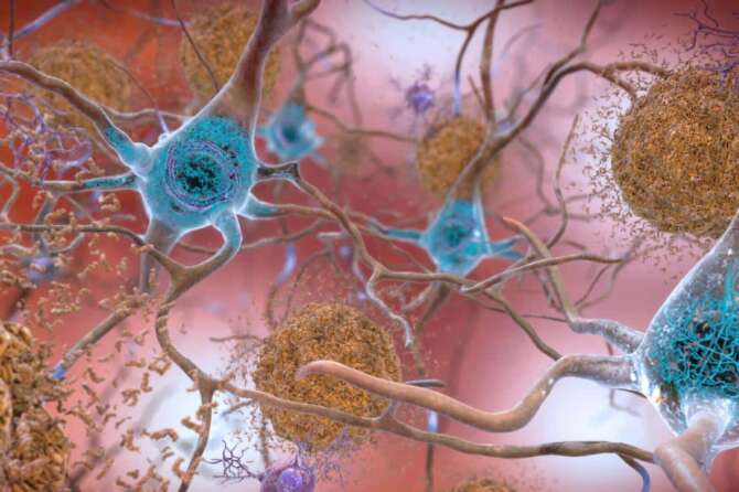 Alzheimer, la speranza da un nuovo farmaco: rallenta la progressione della malattia fino al 35%