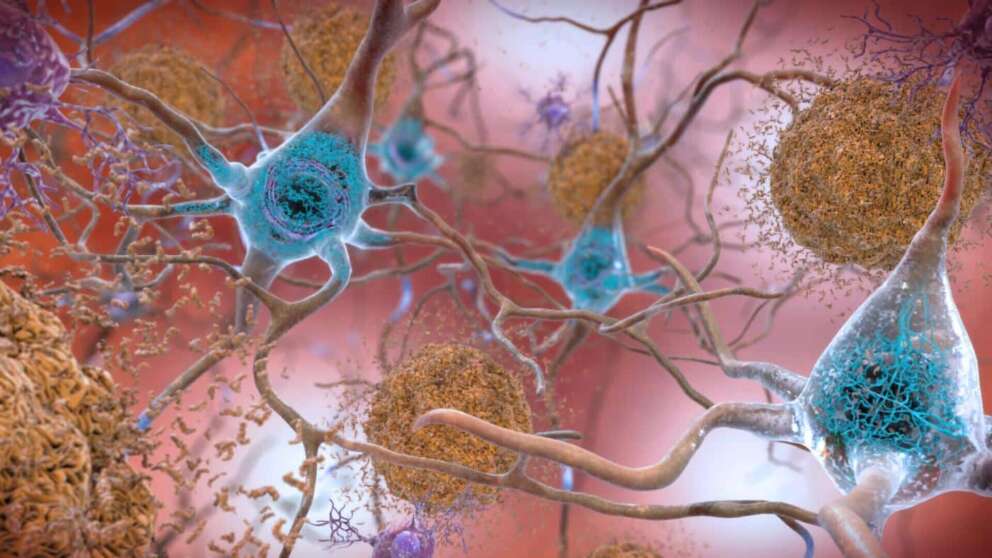 Alzheimer, la speranza da un nuovo farmaco: rallenta la progressione della malattia fino al 35%
