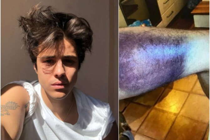 Michele Merlo morto di leucemia, i pm chiedono l’archiviazione: “Troppo tardi per poterlo salvare”