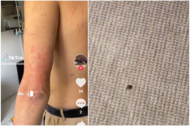 Cosa sono le cimici da letto: punture, cause, rimedi all’infestazione che allarma la Francia e preoccupa l’Italia