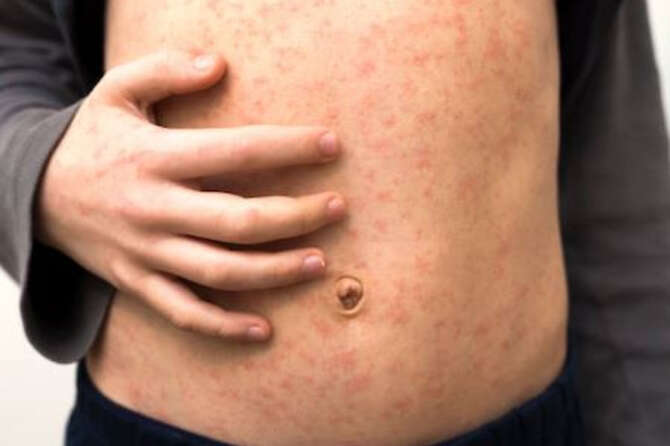 Morbillo, allarme in Europa dopo 7 morti nel 2024: pochi vaccini e crescono i casi, quali sono i sintomi