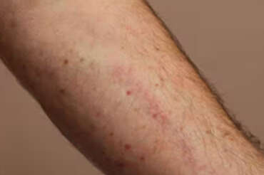 Che cos’è la Sindrome da attivazione mastocitaria (MCAS): sintomi e diagnosi