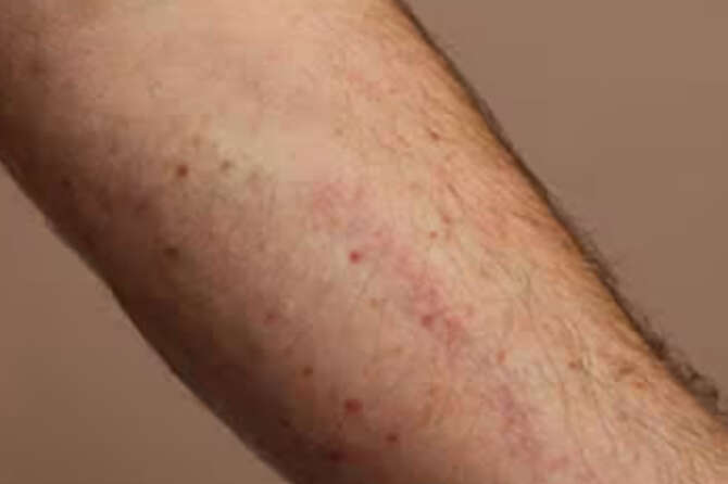 Che cos’è la Sindrome da attivazione mastocitaria (MCAS): sintomi e diagnosi