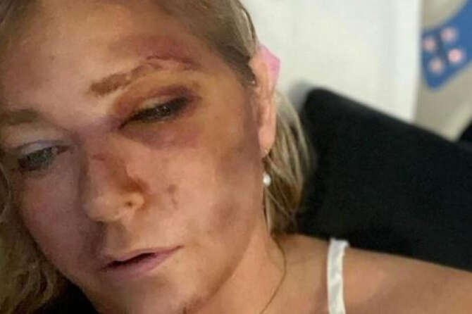 Incidente per Virginia Giuffre, accusatrice del principe Andrea: “Bus mi ha investito a 110 km/h, mi restano 4 giorni di vita”