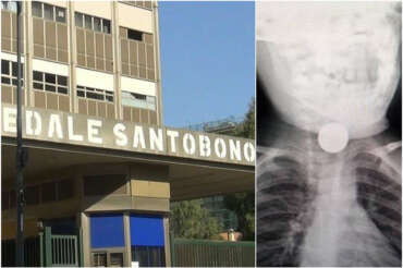 Ingerisce una batteria, bimbo di due anni salvato all’ospedale Santobono di Napoli